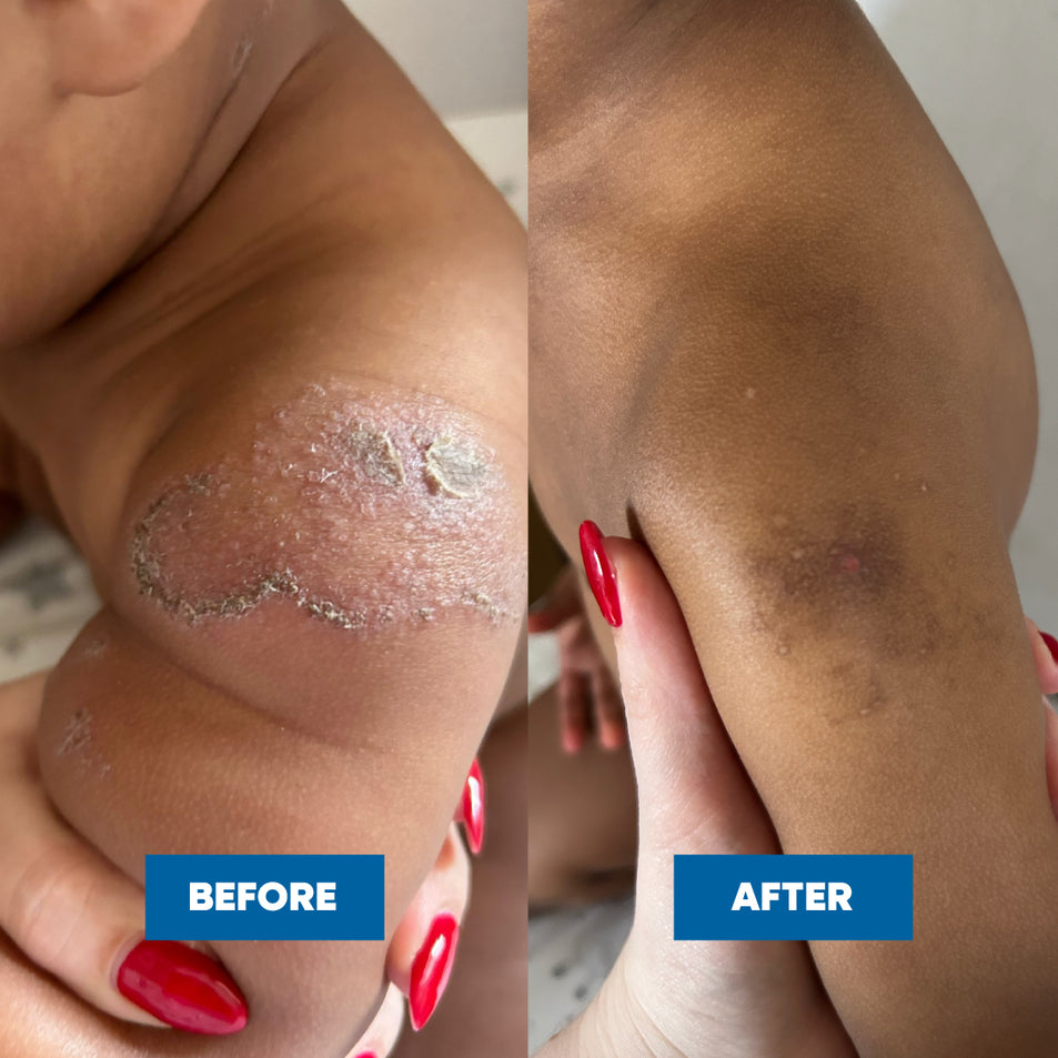 Before and after comparison of a childs arm with visible improvements after using the MooGoo Sensitive Skin Balm and Soothing MSM Moisturiser on his discoid eczema.