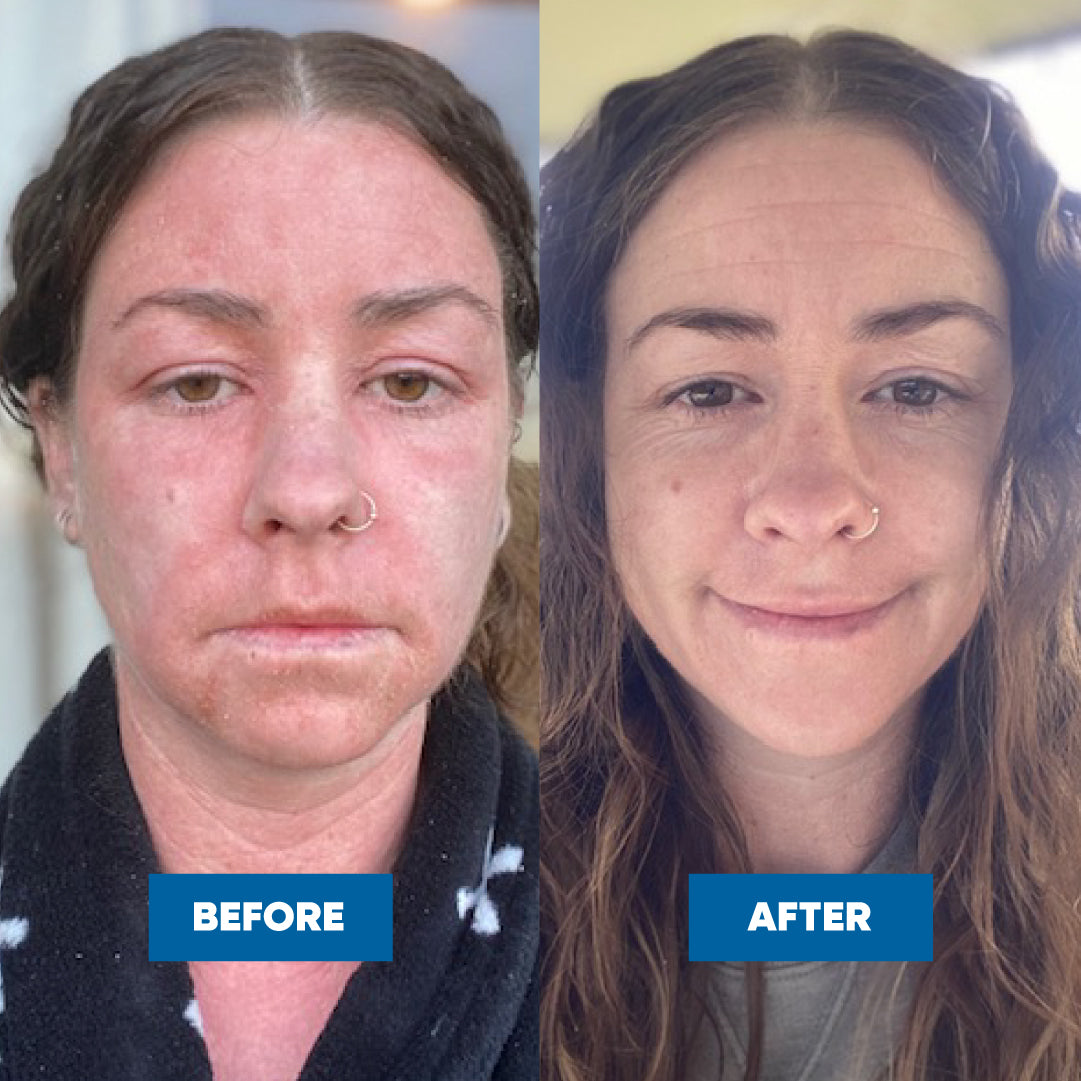 Pink Eczema Cream 100g