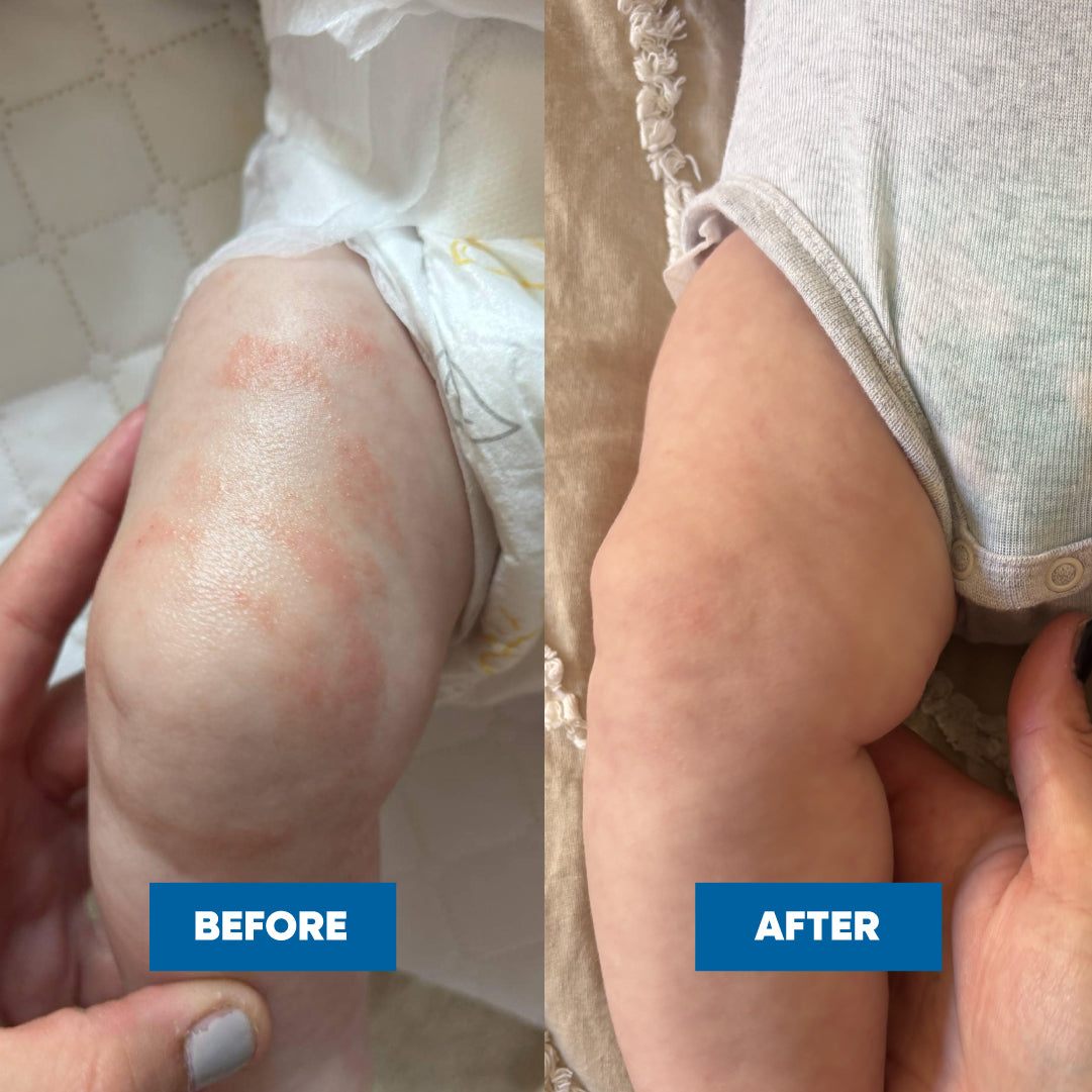 Pink Eczema Cream 100g