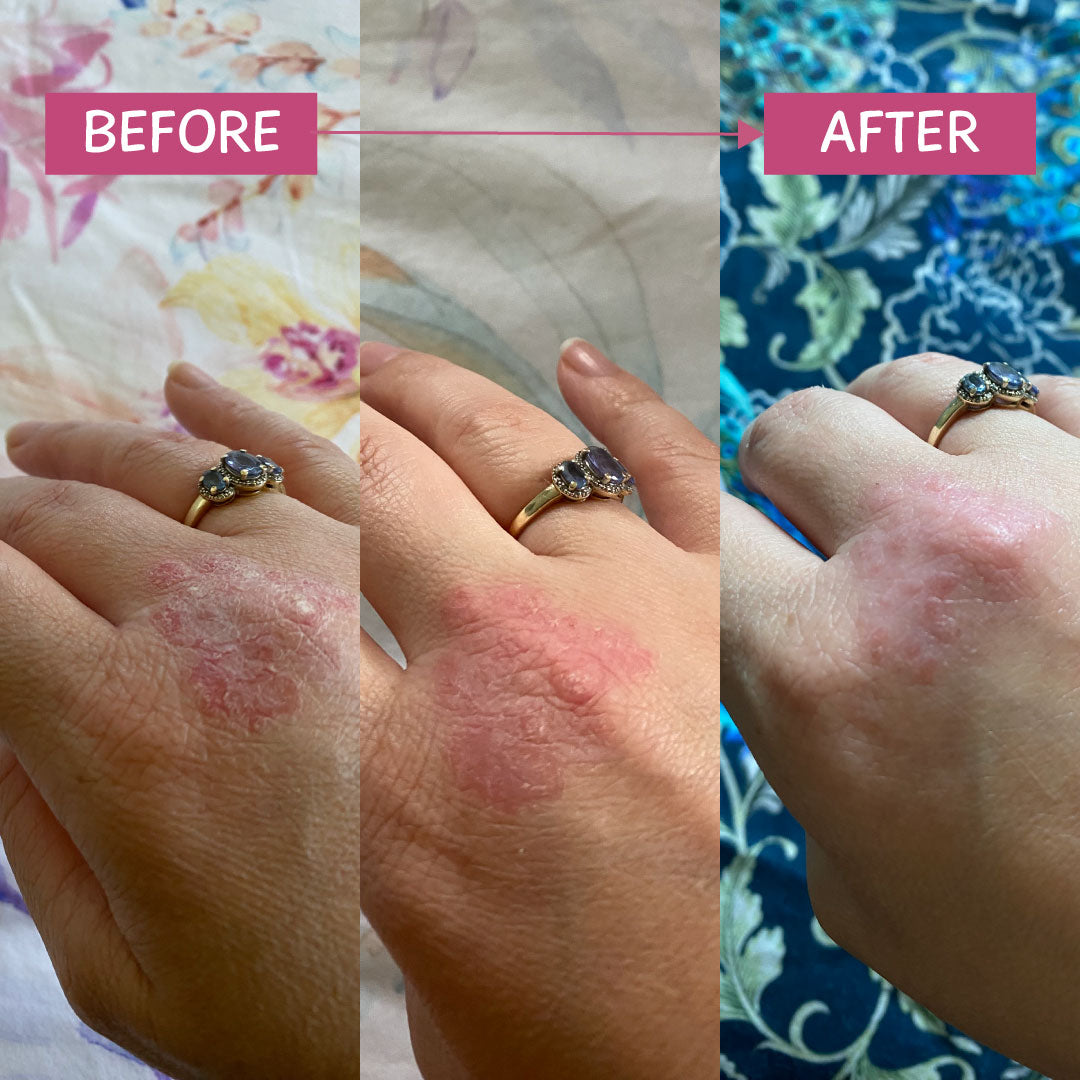 Pink Eczema Cream 100g